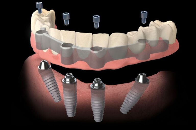 casi-clinici-corso-dentista-villa-pompea-1