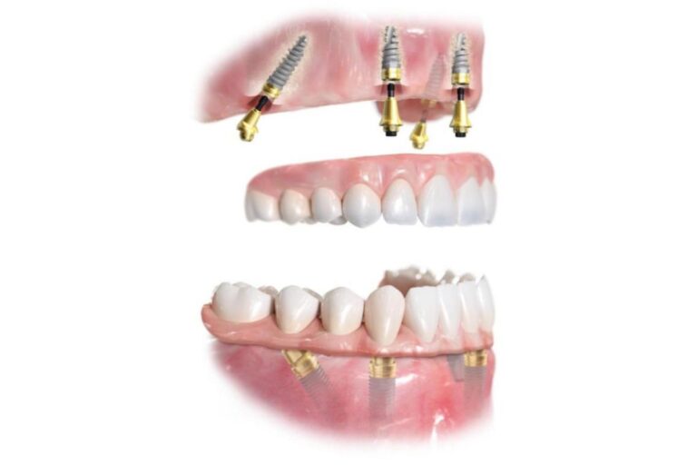 casi-clinici-corso-dentista-villa-pompea-10