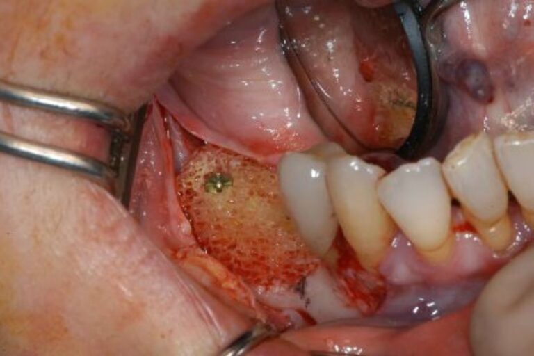 casi-clinici-corso-dentista-villa-pompea-4